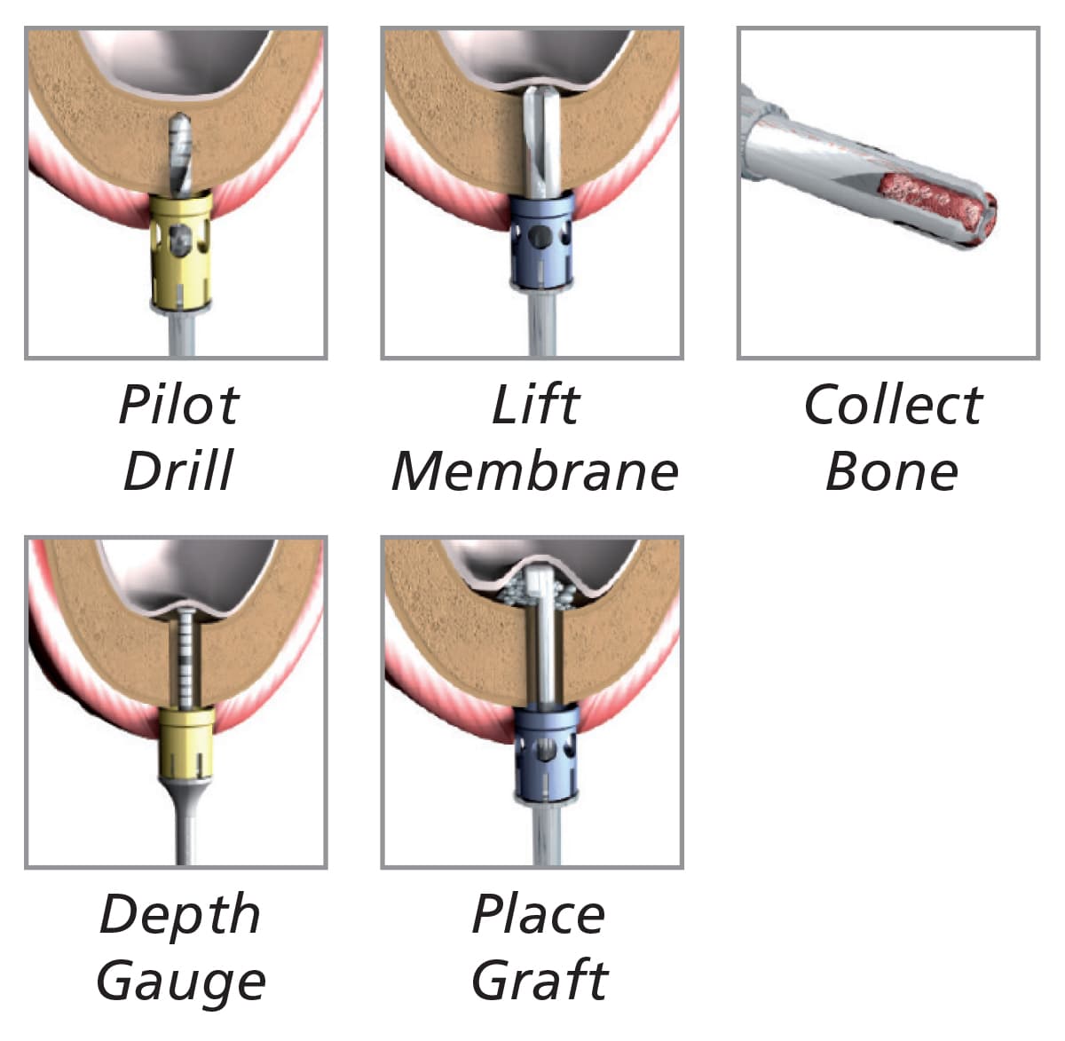 Meisinger Complete Crestal Sinus Lift Kit                                                                    